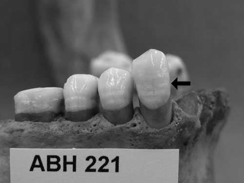 picture of teeth with enamel defects